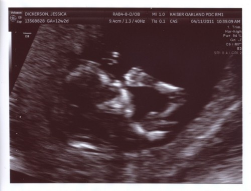 NT ultrasound 2 tiny
